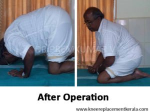 Knee Replacement in kerala